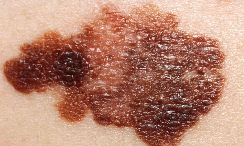 Close up of a melanoma, which appears as a mole with abnormally darkened splotches. Close up of a melanoma, which appears as a mole with abnormally darkened splotches.