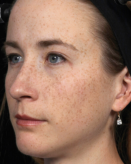 fraxel-freckles-before